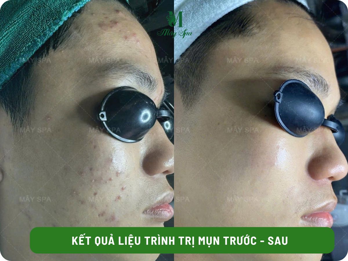 Kết quả điều trị mụn sau 1 liệu trình tại Mây spa