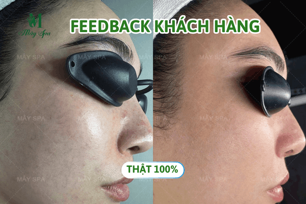 Hiệu quả phục hồi da sau liệu trình đa tầng tại Mây Spa Tân Phú