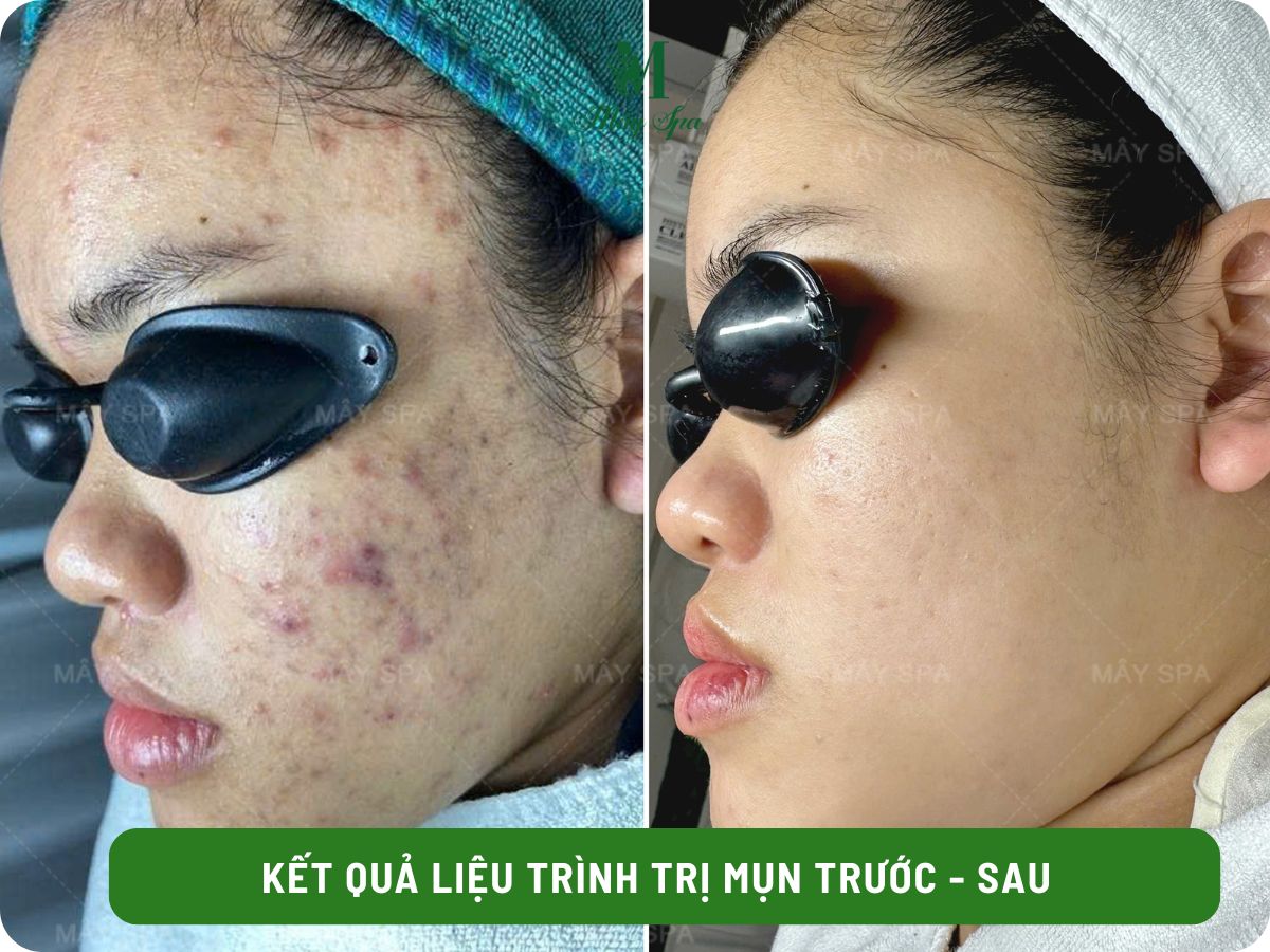 Kết quả điều trị mụn sau 1 liệu trình tại Mây spa
