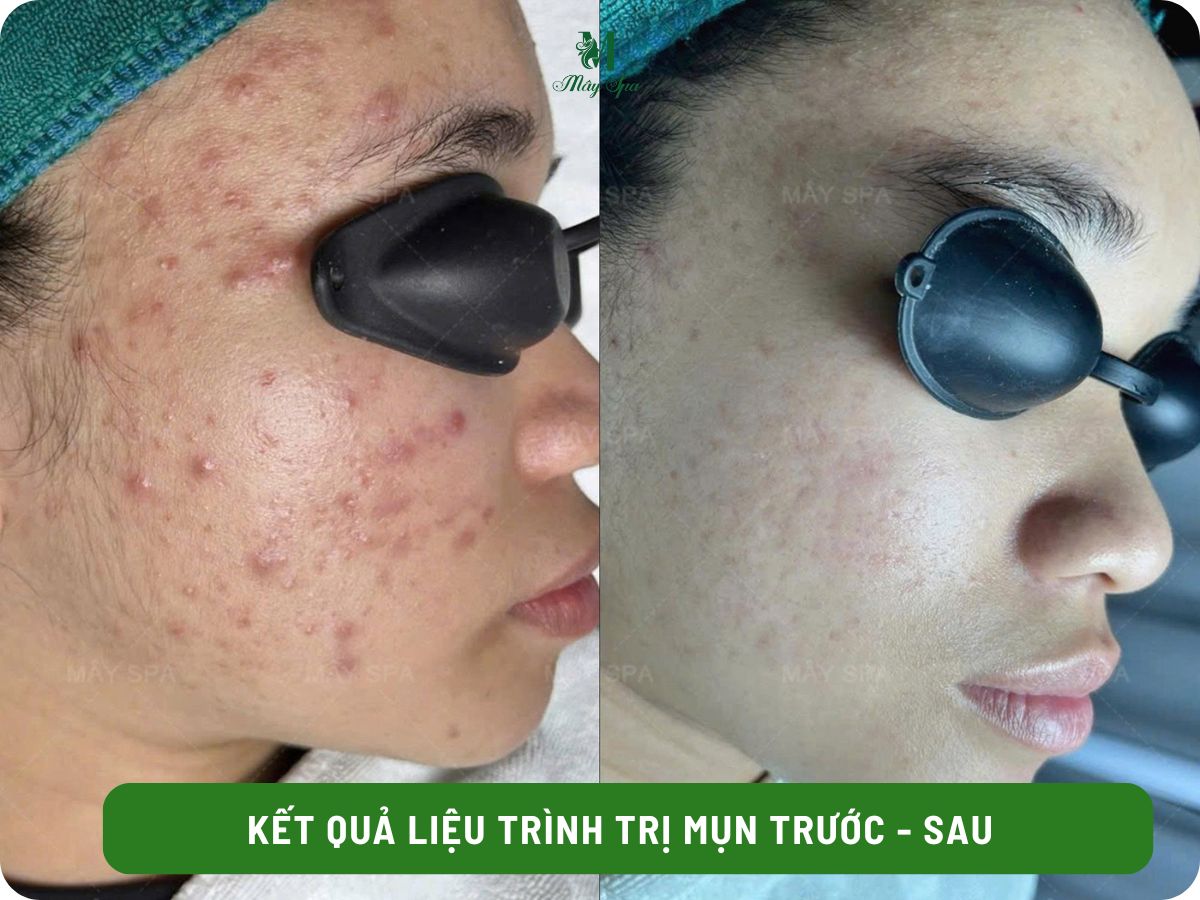 Kết quả điều trị mụn sau 1 liệu trình tại Mây spa