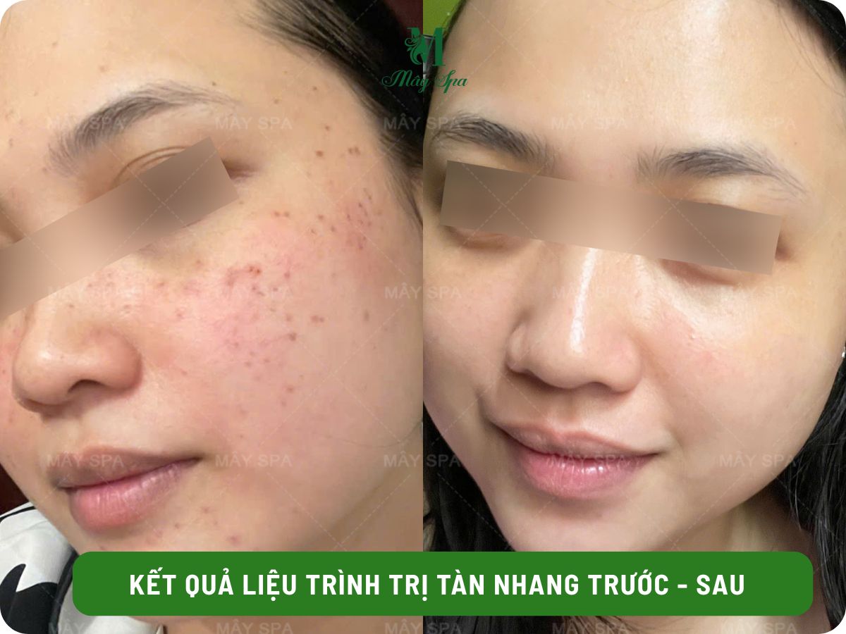 Kết quả điều trị mụn sau 1 liệu trình tại Mây spa