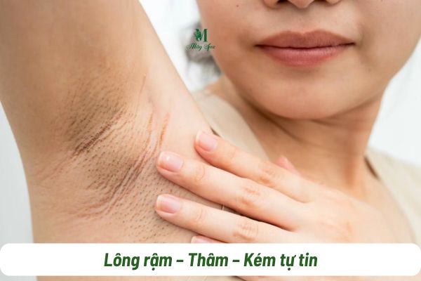 lông nách bikini gây mất tự tin