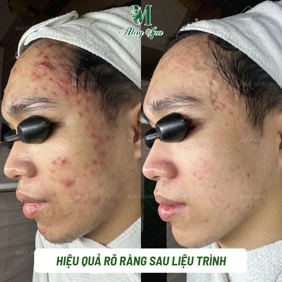kết quả trị mụn nam tại M&acirc;y Spa T&acirc;n Ph&uacute;