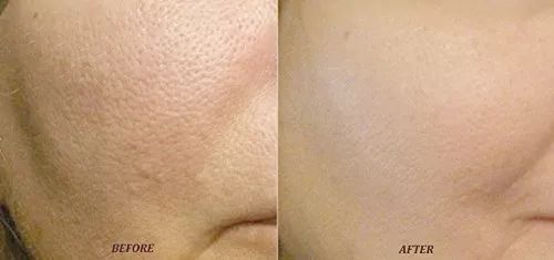 Điều trị lỗ ch&acirc;n l&ocirc;ng to tại M&acirc;y spa