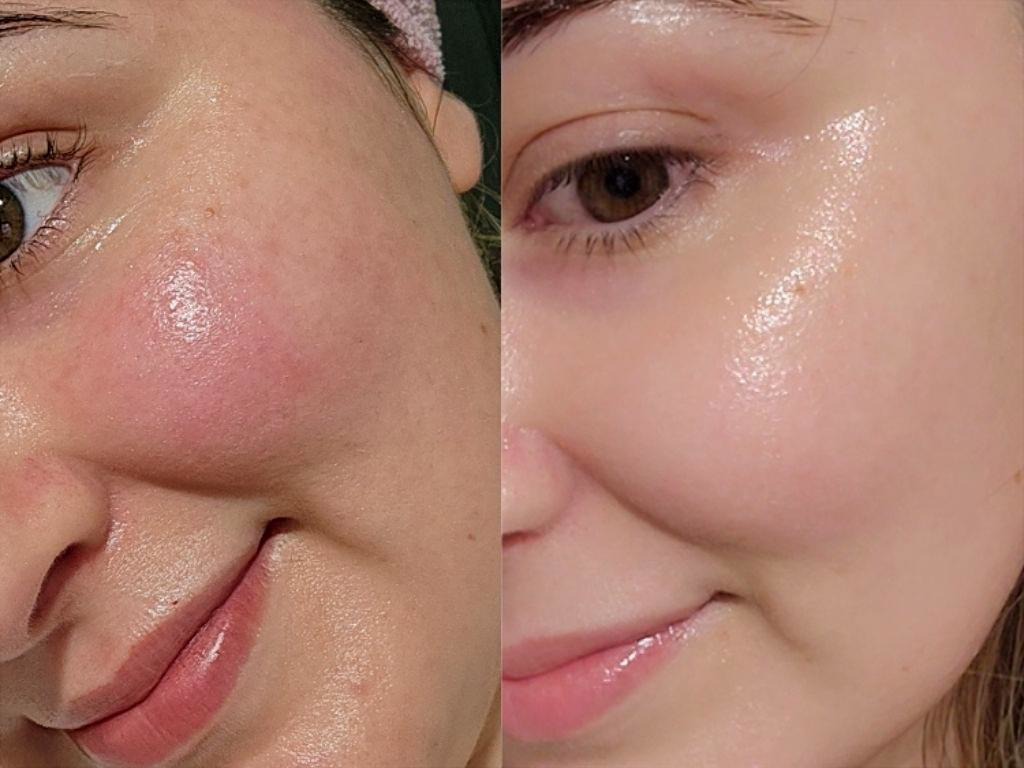 Kết quả sau liệu trình căng bóng da tại Mây spa
