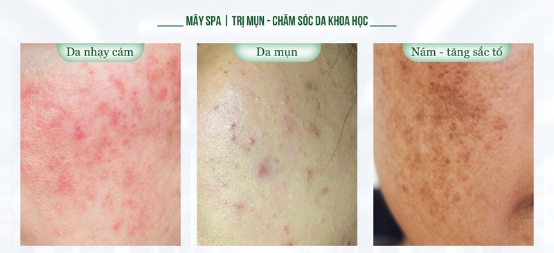 Các liệu trình phục hồi da tại Mây spa Tân Phú