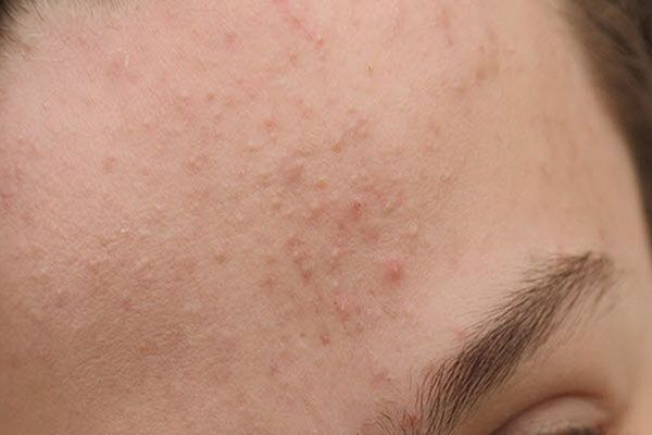 Mụn ẩn thường nằm s&acirc;u dưới da, kh&ocirc;ng c&oacute; đầu mụn trồi l&ecirc;n r&otilde; r&agrave;ng