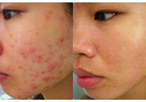 Mụn dậy th&igrave; lu&ocirc;n l&agrave; nỗi &aacute;m ảnh của học sinh lẫn huynh