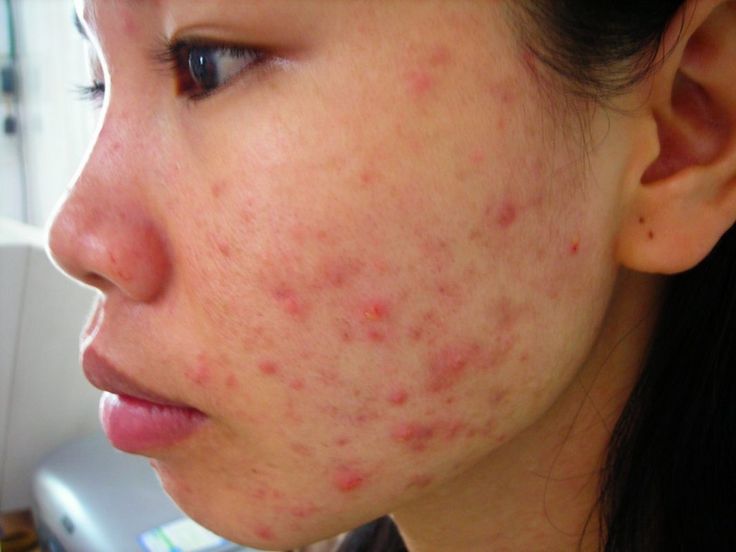 Mụn vi&ecirc;m - Nỗi &aacute;m ảnh của nhiều người