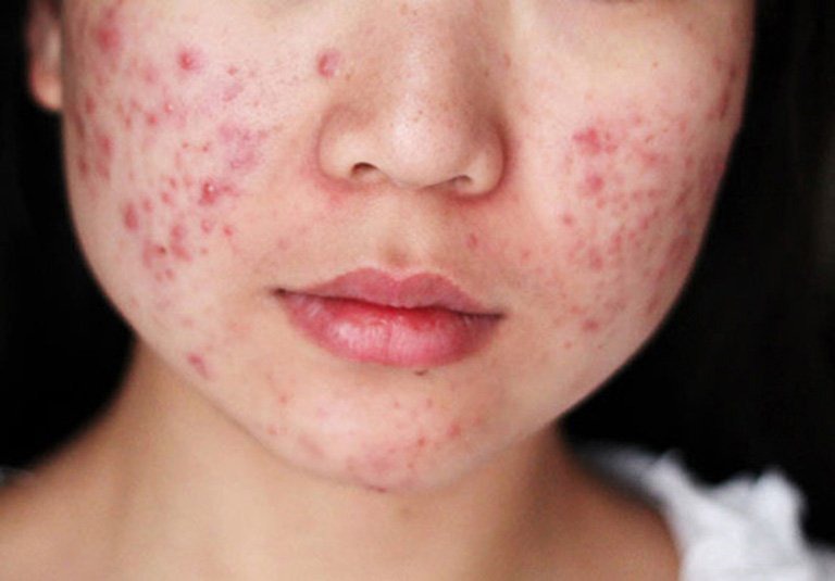 Mụn vi&ecirc;m l&agrave; g&igrave; ?