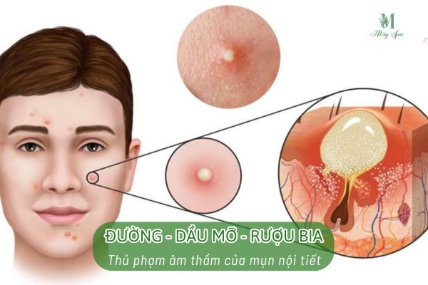 Nguyên nhân mụn nội tiết sau Tết do ăn nhiều đồ ngọt và dầu mỡ