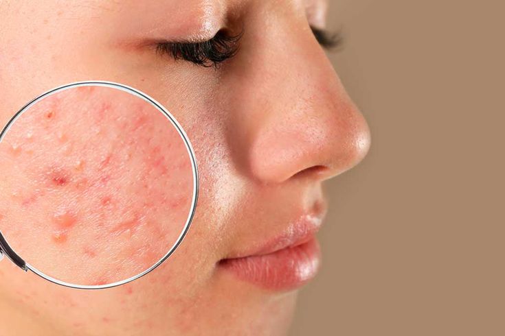 Những t&aacute;c hại đ&aacute;ng sợ của mụn vi&ecirc;m