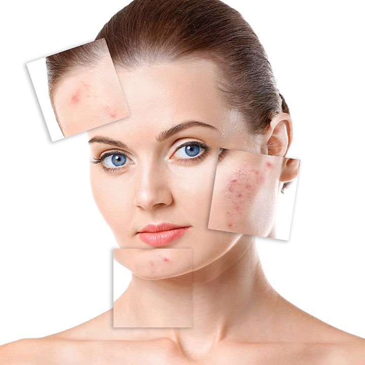 Peel da trị mụn - Chăm s&oacute;c da mụn chuẩn y khoa tại spa
