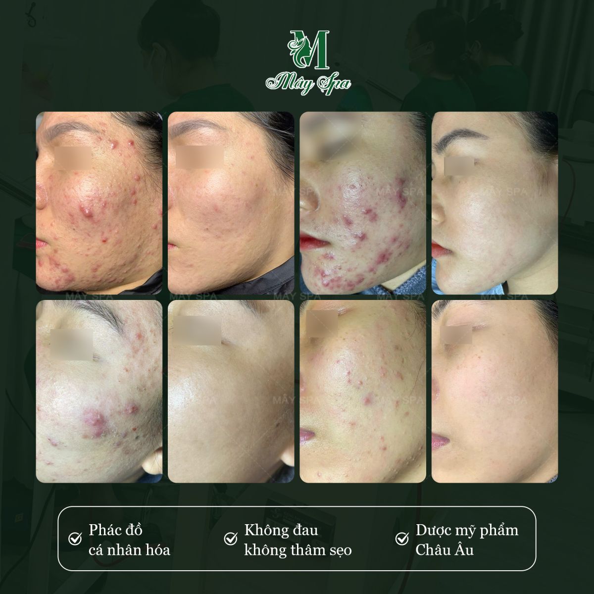 Ph&aacute;c đồ điều trị mụn c&aacute; nh&acirc;n h&oacute;a sẽ gi&uacute;p bạn lấy lại " thanh xu&acirc;n " cho l&agrave;n da