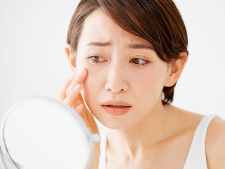Da tăng sắc tố sẽ trờ nên sẫm màu, dẫn đến tàn nhang, nám hoặc da không đều màu