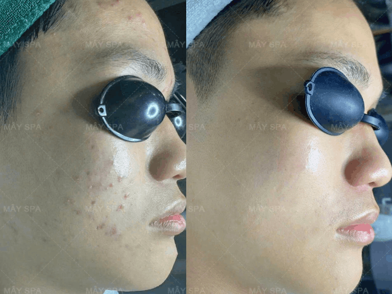 Feedback kết quả trị mụn tại Mây Spa Tân Phú