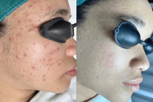 Kết quả sau liệu trình trị mụn tại Mây Spa Tân Phú