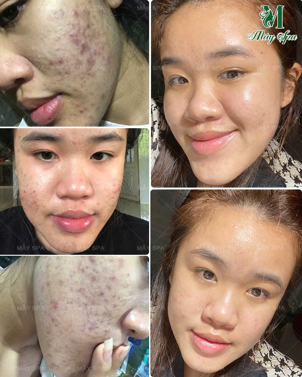 Liệu tr&igrave;nh xử l&yacute; mụn vi&ecirc;m chuẩn y khoa tại M&acirc;y spa