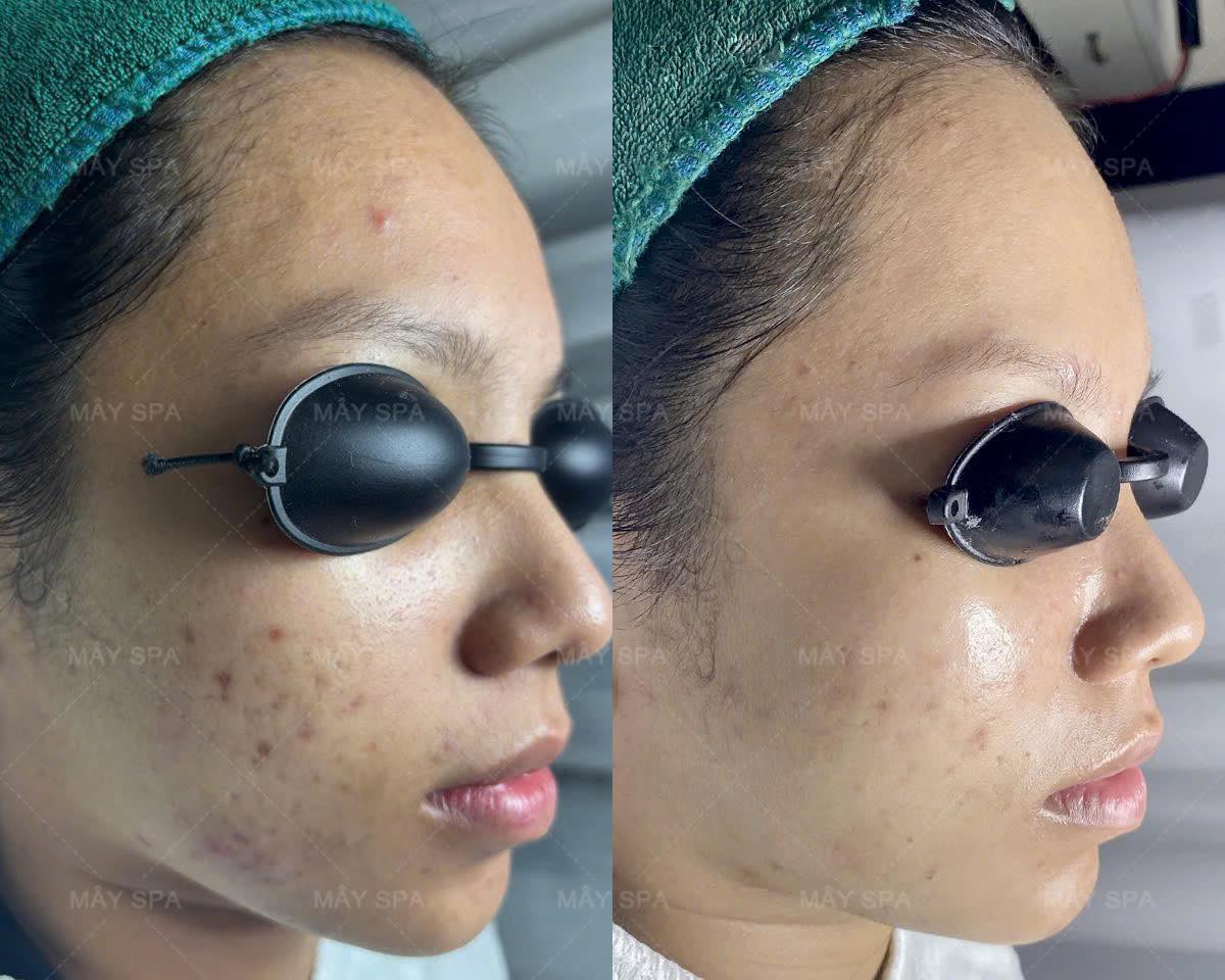 Kết quả kh&aacute;ch đang trị mụn tại M&acirc;y Spa