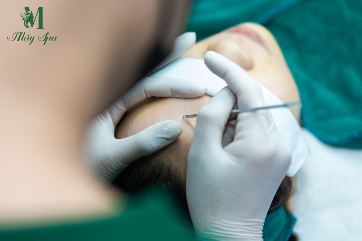 M&acirc;y spa - địa chỉ nặn mụn v&agrave; điều trị mụn chuẩn y khoa uy t&iacute;n tại TpHCM