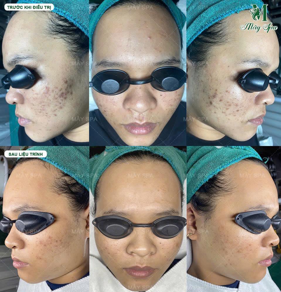 Kết quả liệu tr&igrave;nh trị mụn bằng Chemical Peel