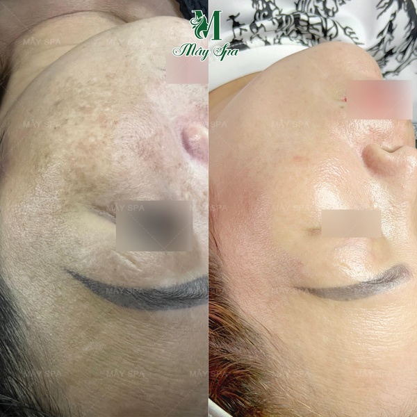 Kết quả Peel da trị nám