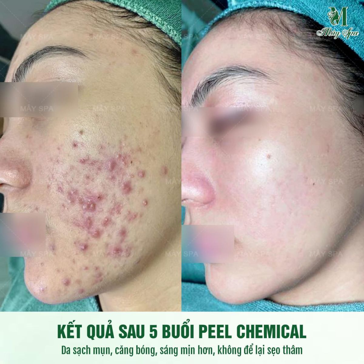 Kết quả liệu tr&igrave;nh chemical peel trị mụn tại M&acirc;y spa