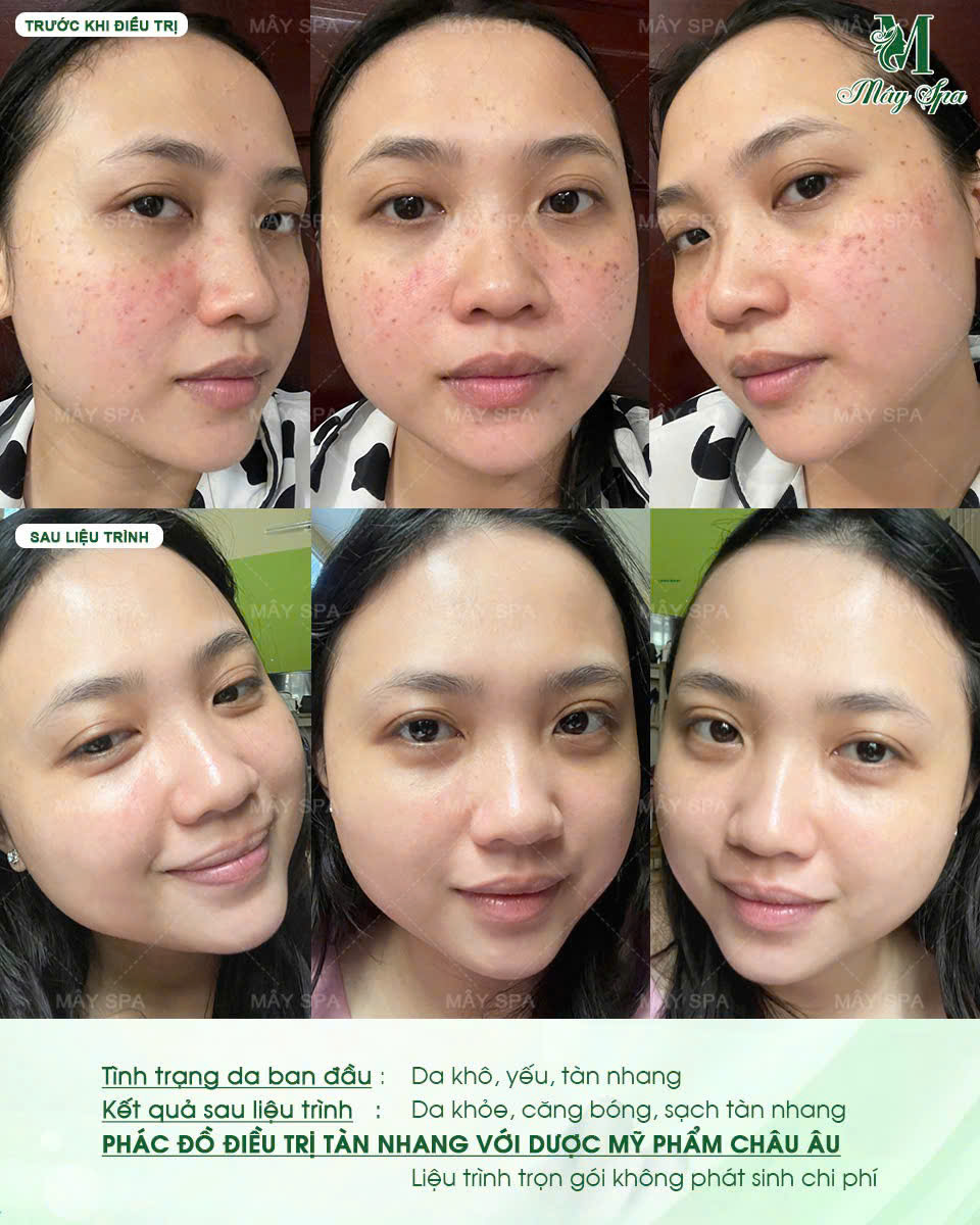 Kết quả peel da trị tàn nhang tại Mây spa Tân Phú