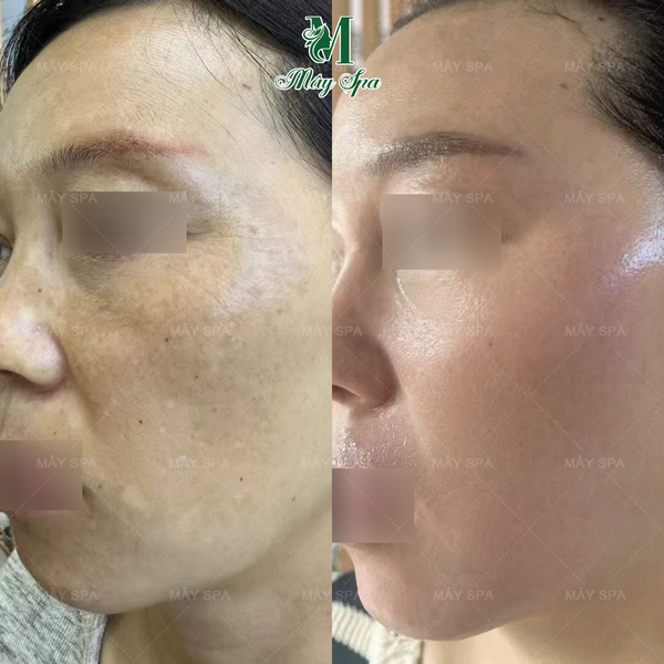 feed back peel da trị nám