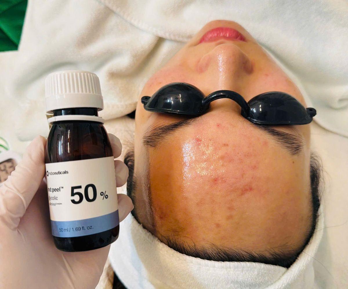 Peel da nhạy cảm tại Mây Spa luôn mang lại sự yên tâm cho khách hàng