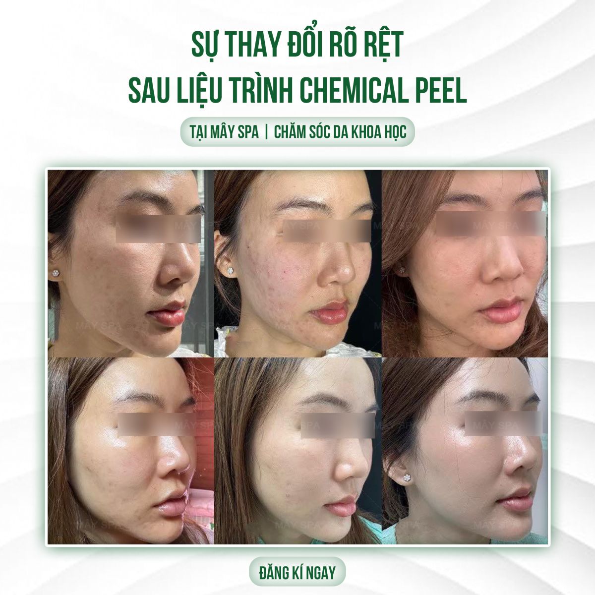 Kết quả sau liệu tr&igrave;nh Peel da trị th&acirc;m tại M&acirc;y spa