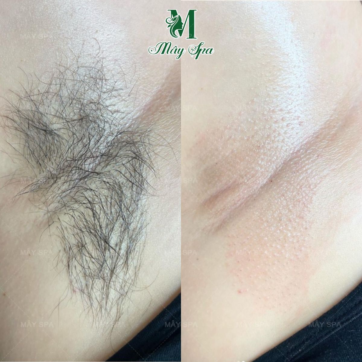 Hiệu quả triệt lông công nghệ Diode laser tại Mây spa tân phú