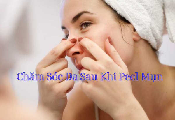Chăm Sóc Da Sau Khi Peel Mụn Đúng Cách – Yếu Tố Quyết Định Làn Da Có Hết Mụn Hay Không