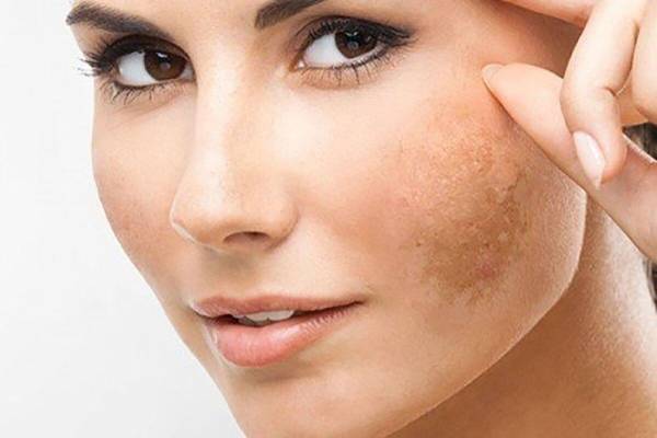 Da sạm, nám nhẹ – Có nên peel da không? Chuyên gia giải đáp