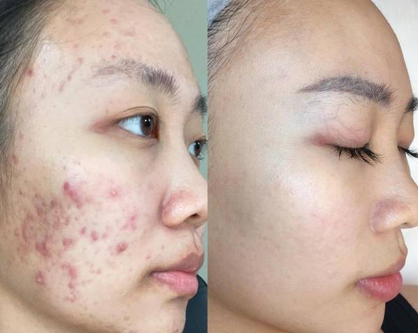 Da thâm mụn nên sử dụng dịch vụ nào nhanh trắng và mờ thâm tại spa?