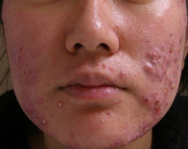 Mụn viêm có nguy hiểm không? Cách chăm sóc da giảm sưng viêm hiệu quả
