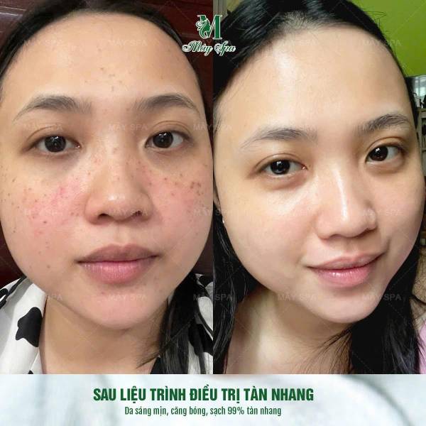 Chữa Tàn Nhang Bằng Phương Pháp Peel Da – Giải Pháp Hiệu Quả Cho Làn Da Sáng Mịn | Mây Spa