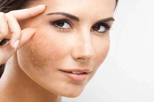 Peel da trị nám an toàn | Mây Spa Tân Phú