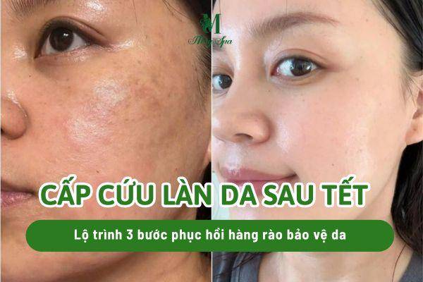 “Cấp cứu” làn da sau Tết: Lộ trình 3 bước phục hồi hàng rào bảo vệ da chuyên sâu