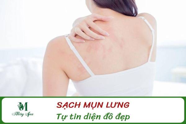 Spa Trị Mụn Lưng Hiệu Quả Tân Phú: Giải Pháp Sạch Mụn – Hết Thâm – Tự Tin Diện Đồ Hở Lưng
