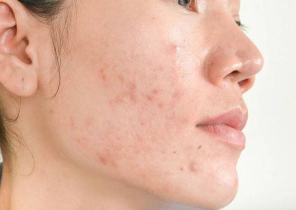 Da Thường Bị Thâm Sau Điều Trị Mụn - Đâu Là Lý Do ?